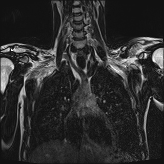 Bilateral spinoglenoid notch ganglion cysts (Radiopaedia 29577-30082 Coronal T2 48).jpg