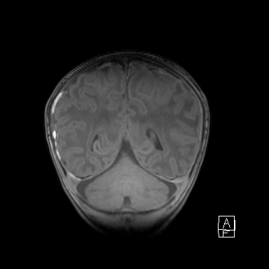 Bilateral subdural hemorrhage and parietal skull fracture (Radiopaedia 26058-26190 Coronal T1 40).png