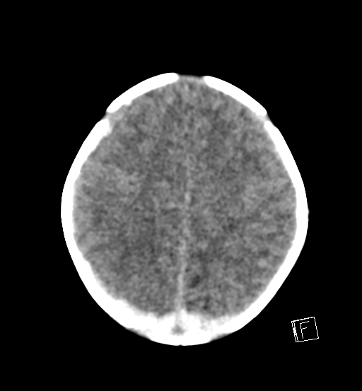 File:Bilateral subdural hemorrhage and parietal skull fracture (Radiopaedia 26058-26192 Axial non-contrast 7).png