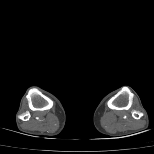 Bilateral superficial femoral arterial occlusion (Radiopaedia 25682-25857 A 63).jpg