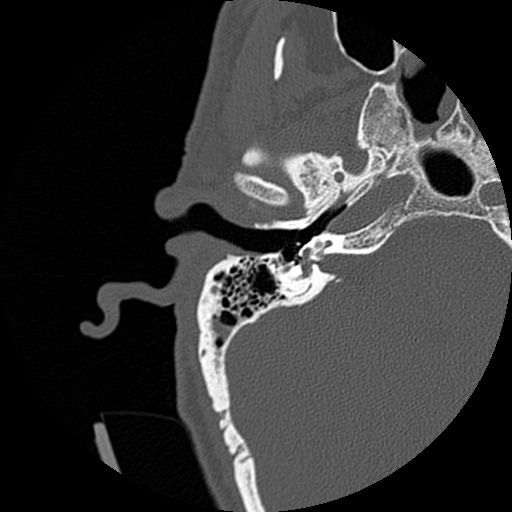File:Bilateral temporal bone fractures (Radiopaedia 29482-29970 Axial non-contrast 15).jpg