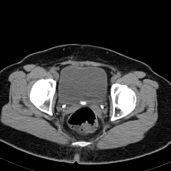 Bilateral ureteric stents (Radiopaedia 48795-53825 Axial non-contrast 62).jpg