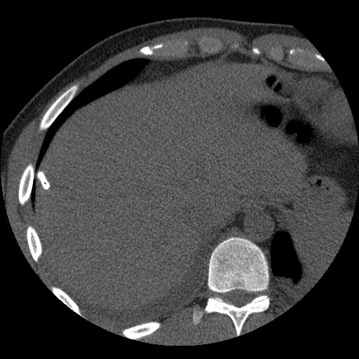 Bile leak from liver traumatic laceration (Radiopaedia 63463-72077 Axial Biliscopin 15).jpg