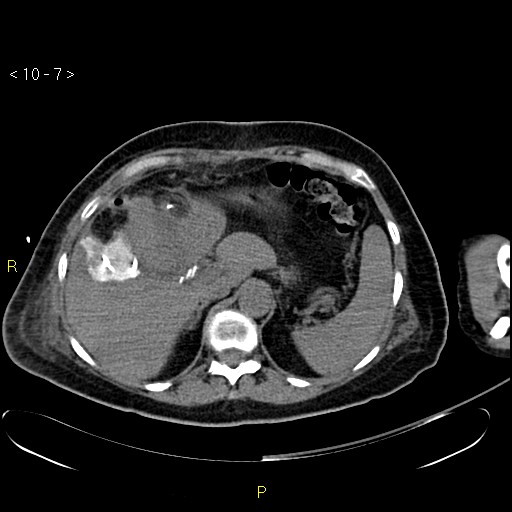 File:Biloma with drainage into the colon (Radiopaedia 20032-20068 B 7).jpg