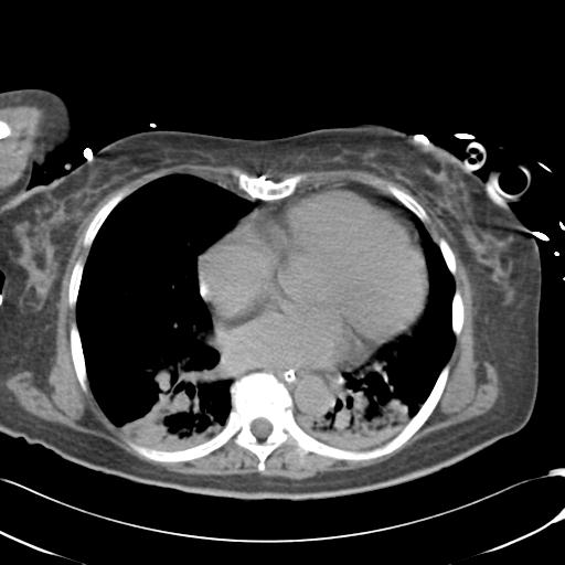 Bladder rupture post renal biopsy (Radiopaedia 30863-31572 Axial non-contrast 1).jpg
