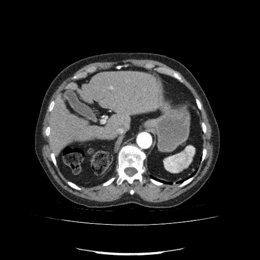 File:Bladder tumor detected on trauma CT (Radiopaedia 51809-57609 A 83).jpg