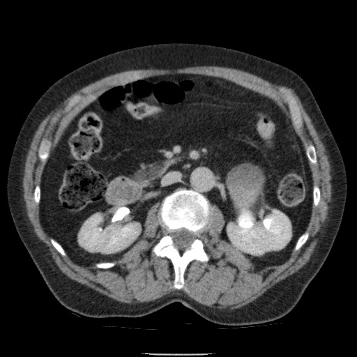 Bladder tumor detected on trauma CT (Radiopaedia 51809-57609 C 55).jpg