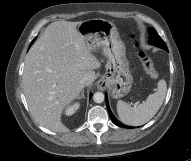File:Bleeding duodenal ulcer and adenomyomatosis of gallbladder (Radiopaedia 61834-69861 A 22).jpg