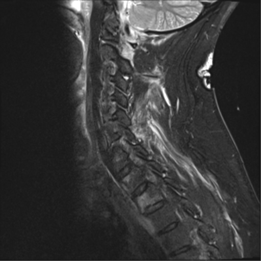File:Blunt cerebrovascular injury (Radiopaedia 53682-59744 Sagittal T2 fat sat 4).png