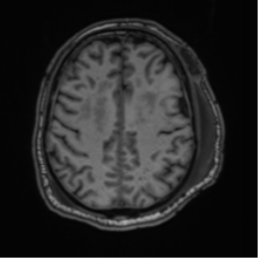 File:Blunt cerebrovascular injury (Radiopaedia 53682-59745 Axial T1 23).png