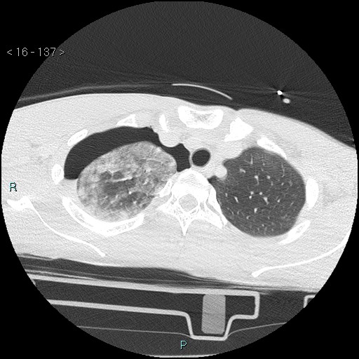 Blunt chest trauma (Swiss cheese sign) (Radiopaedia 38519-40618 Axial lung window 11).jpg