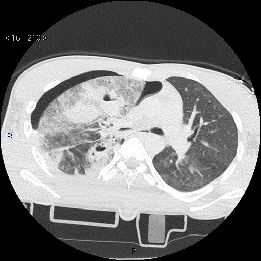 Blunt chest trauma (Swiss cheese sign) (Radiopaedia 38519-40618 Axial lung window 28).jpg