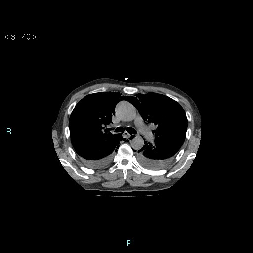File:Boerhaave syndrome (Radiopaedia 27683-27897 Axial non-contrast 40).jpg