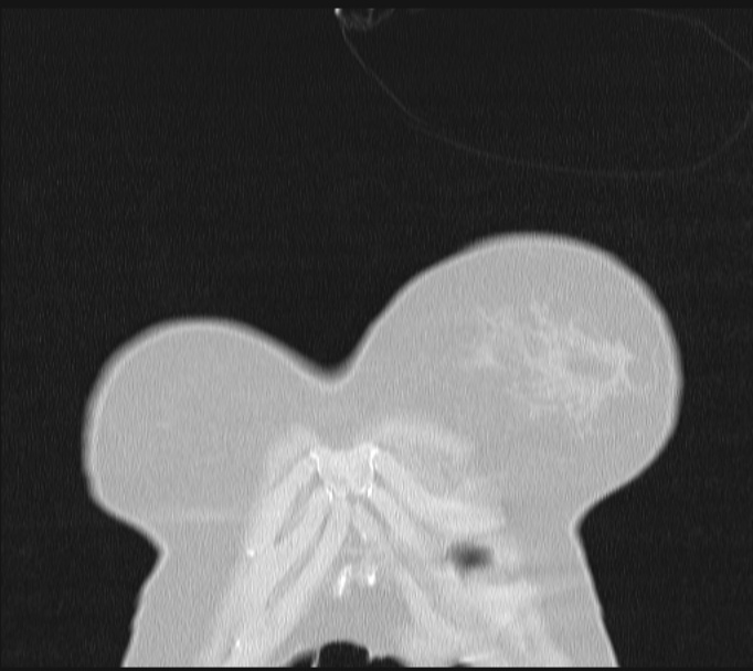 Boerhaave syndrome (Radiopaedia 45644-49799 Coronal lung window 3).jpg