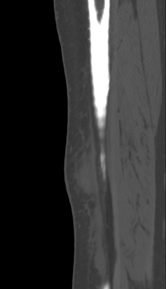 Bone metastasis - tibia (Radiopaedia 57665-64609 Sagittal bone window 36).jpg