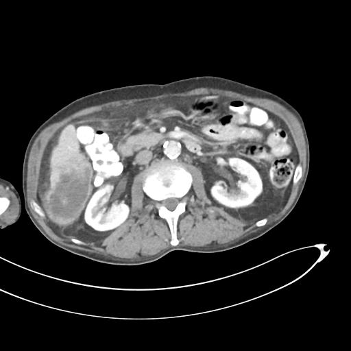 Bone metastasis from squamous cell carcinoma (Radiopaedia 30133-30730 B 31).jpg