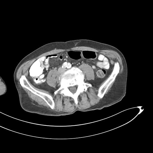 Bone metastasis from squamous cell carcinoma (Radiopaedia 30133-30730 B 47).jpg