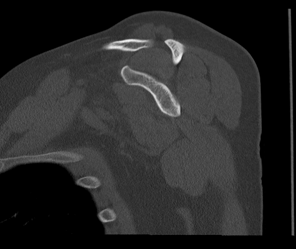 Bony Bankart and Hill-Sachs lesions (Radiopaedia 33622-34727 Sagittal bone window 35).png