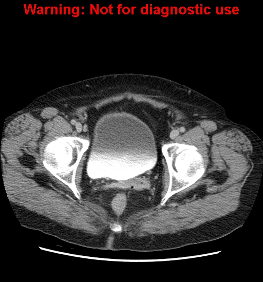 File:Bosniak renal cyst - type II (Radiopaedia 23404-23468 F 63).jpg