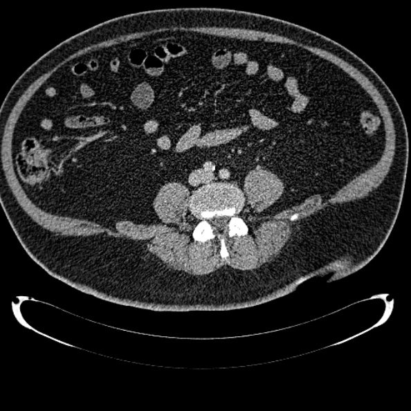 File:Bosniak renal cyst - type IV (Radiopaedia 24244-24518 C 246).jpg