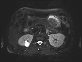 File:Bouveret syndrome (Radiopaedia 61017-68856 Axial MRCP 26).jpg