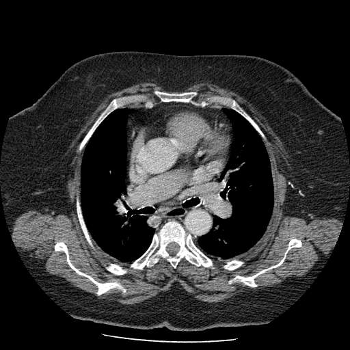 Bovine aortic arch - right internal mammary vein drains into the superior vena cava (Radiopaedia 63296-71875 A 66).jpg