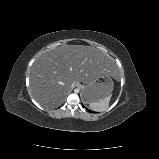Bowel and splenic infarcts in acute lymphocytic leukemia (Radiopaedia 61055-68915 A 30).jpg