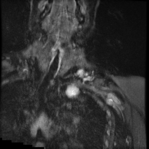 File:Brachial plexus neurofibroma (Radiopaedia 28030-28291 Coronal STIR 13).png