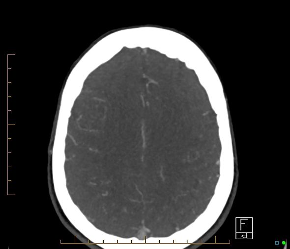 Brachiocephalic trunk stenosis (Radiopaedia 87242-103519 A 19).jpg
