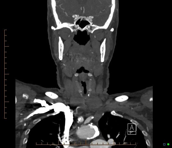 Brachiocephalic trunk stenosis (Radiopaedia 87242-103519 B 29).jpg