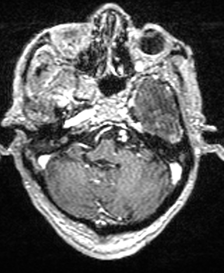 Brain abscess with dual rim sign (Radiopaedia 87566-103938 Axial T1 C+ 42).jpg