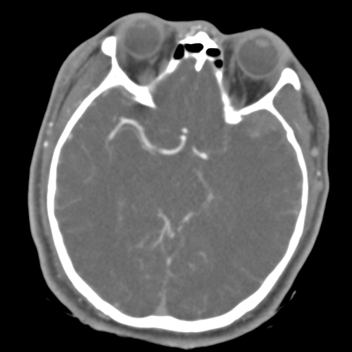 File:Brain contusions, internal carotid artery dissection and base of skull fracture (Radiopaedia 34089-35339 D 31).png