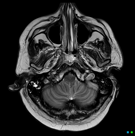 File:Brain death on MRI and CT angiography (Radiopaedia 42560-45689 Axial T2 6).jpg