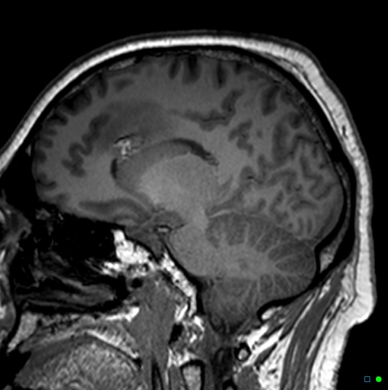 Brain death on MRI and CT angiography (Radiopaedia 42560-45689 Sagittal T1 13).jpg