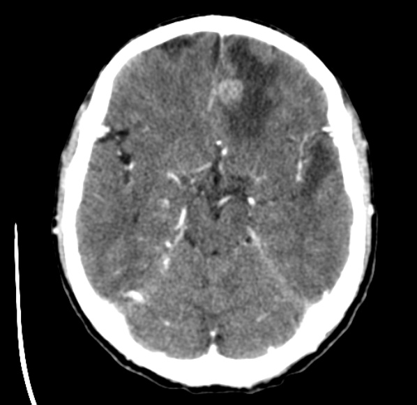 File:Brain metastases from lung cancer (Radiopaedia 24480-24781 Axial C+ delayed 21).jpg