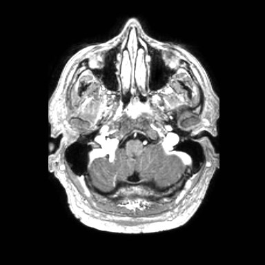File:Brain metastases from lung cancer (Radiopaedia 83839-99028 Axial T1 C+ 5).jpg