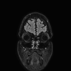 Brain metastases from lung cancer (Radiopaedia 83839-99028 Coronal FLAIR 5).jpg