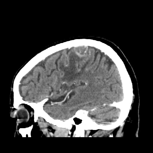 Brain metastasis (Radiopaedia 42617-45760 D 44).jpg