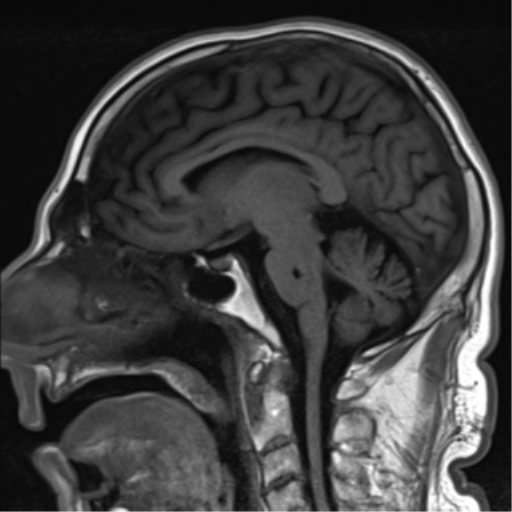 File:Brain metastasis (large cystic mass) (Radiopaedia 47497-52107 Sagittal T1 14).png