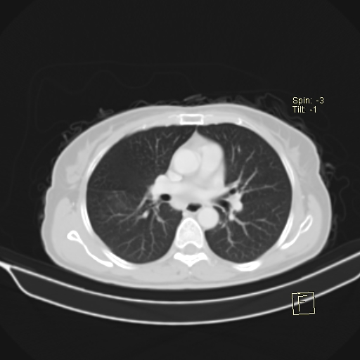 Brain metastasis as initial presentation of non-small cell lung cancer (Radiopaedia 65122-74127 Axial lung window 23).jpg