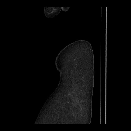 Breast cancer pseudocirrhosis (Radiopaedia 65406-74454 C 23).jpg