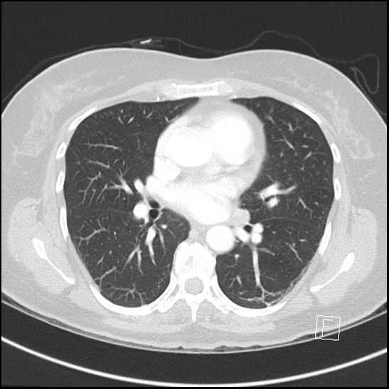 Breast metastases from renal cell cancer (Radiopaedia 79220-92225 Axial lung window 44).jpg