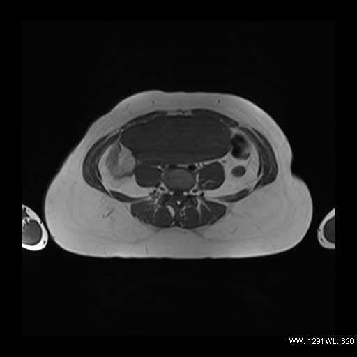 File:Broad ligament fibroid (Radiopaedia 49135-54241 Axial T1 4).jpg