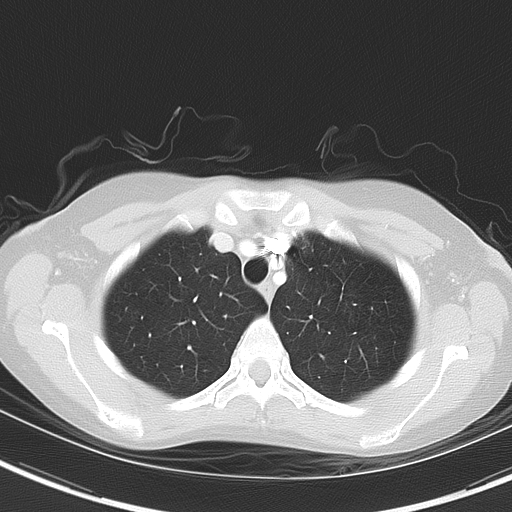 File:Bronchial atresia (Radiopaedia 73677-84470 Axial lung window 14).jpg