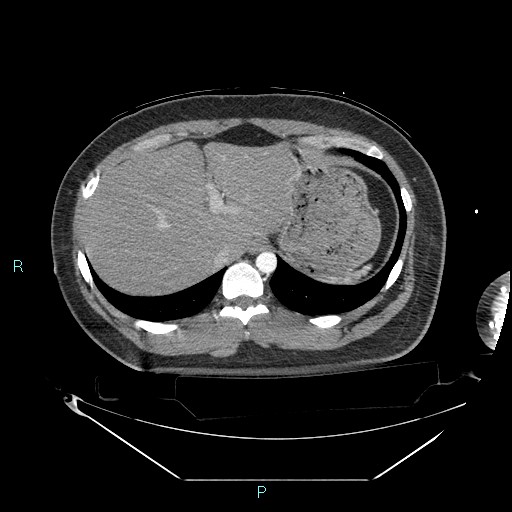 Bronchial carcinoid tumor (Radiopaedia 78272-90870 B 107).jpg