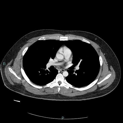 Bronchial carcinoid tumor (Radiopaedia 78272-90875 A 49).jpg