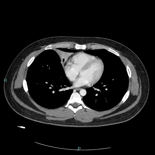 Bronchial carcinoid tumor (Radiopaedia 78272-90875 A 61).jpg