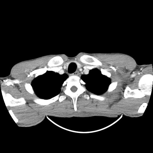 Bronchial carcinoid tumor causing right lower lobe collapse (Radiopaedia 83495-98594 A 2).jpg