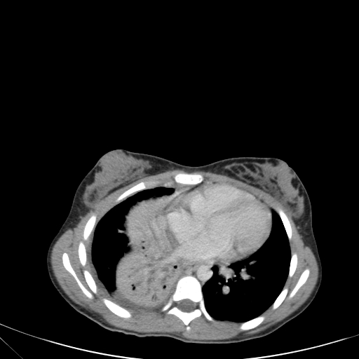Bronchial mucoepidermoid carcinoma (Radiopaedia 57023-63895 Axial 64).jpg