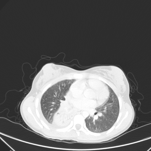 Bronchial mucoepidermoid carcinoma (Radiopaedia 57023-63895 Axial lung window 60).jpg